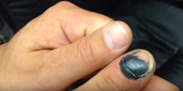 травма пальца ногтя