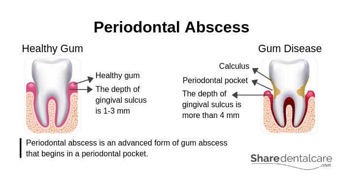 Periodontal Abscess