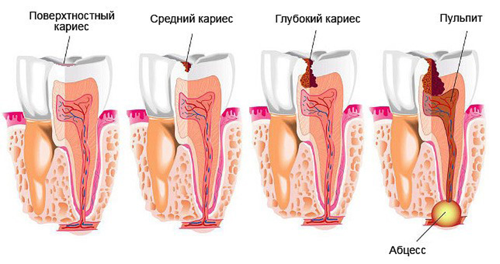 периапикальный абсцесс