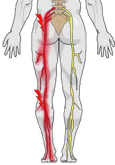 ишиалгия симптомы и лечение 