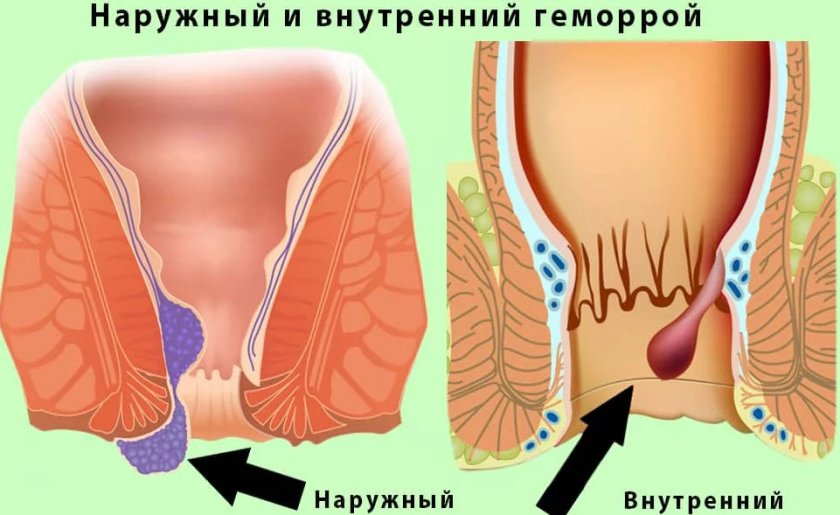 Пшено при геморрое