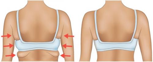 Жир на спине гормоны. Причины отложения жира на спине у женщин