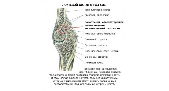 Стоит признать, что жим узким хватом на трицепс, это упражнение не для новичков. Они часто выполняют его с нарушениями, что приводит к получению болезненных травм.