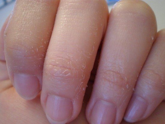 Сухость и шелушение кожи на пальцах рук. Причины и лечение кожи рук