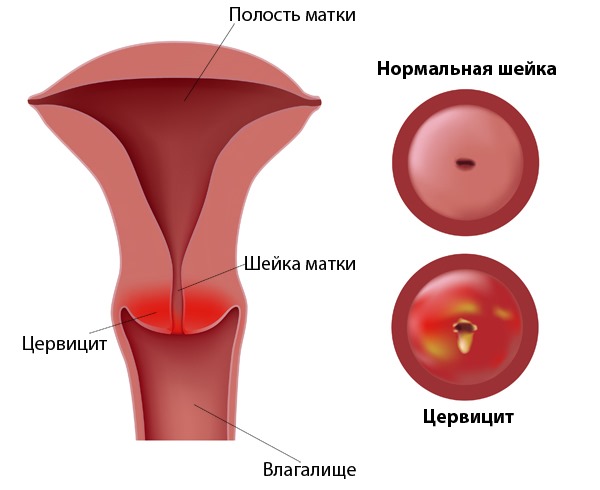 Коккобациллярная флора в мазке: что это такое у мужчин, женщин, при беременности. Норма, как и чем лечить отклонение