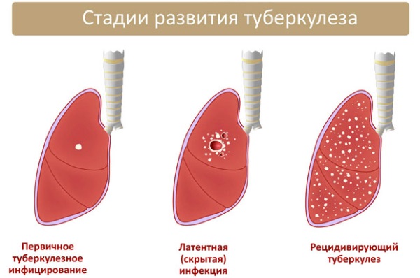 Привкус железа во рту. Причины во время еды, при беременности, месячных, при кашле, по утрам, при сухости на языке, тошноте