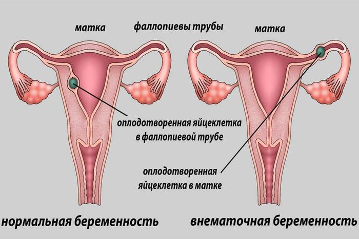 Гонококки в мазке у женщин. Что это такое, причины, симптомы и лечение