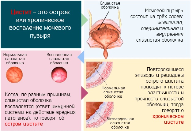 Красная моча у женщины. Причины боли, после 40-50 лет, с осадком, сгустки, при беременности