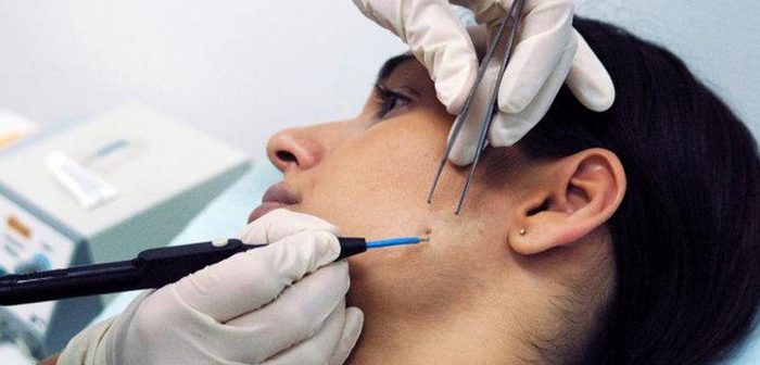 оперативное лечение кожи лица