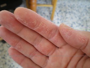 Почему шелушится кожа на ладонях рук