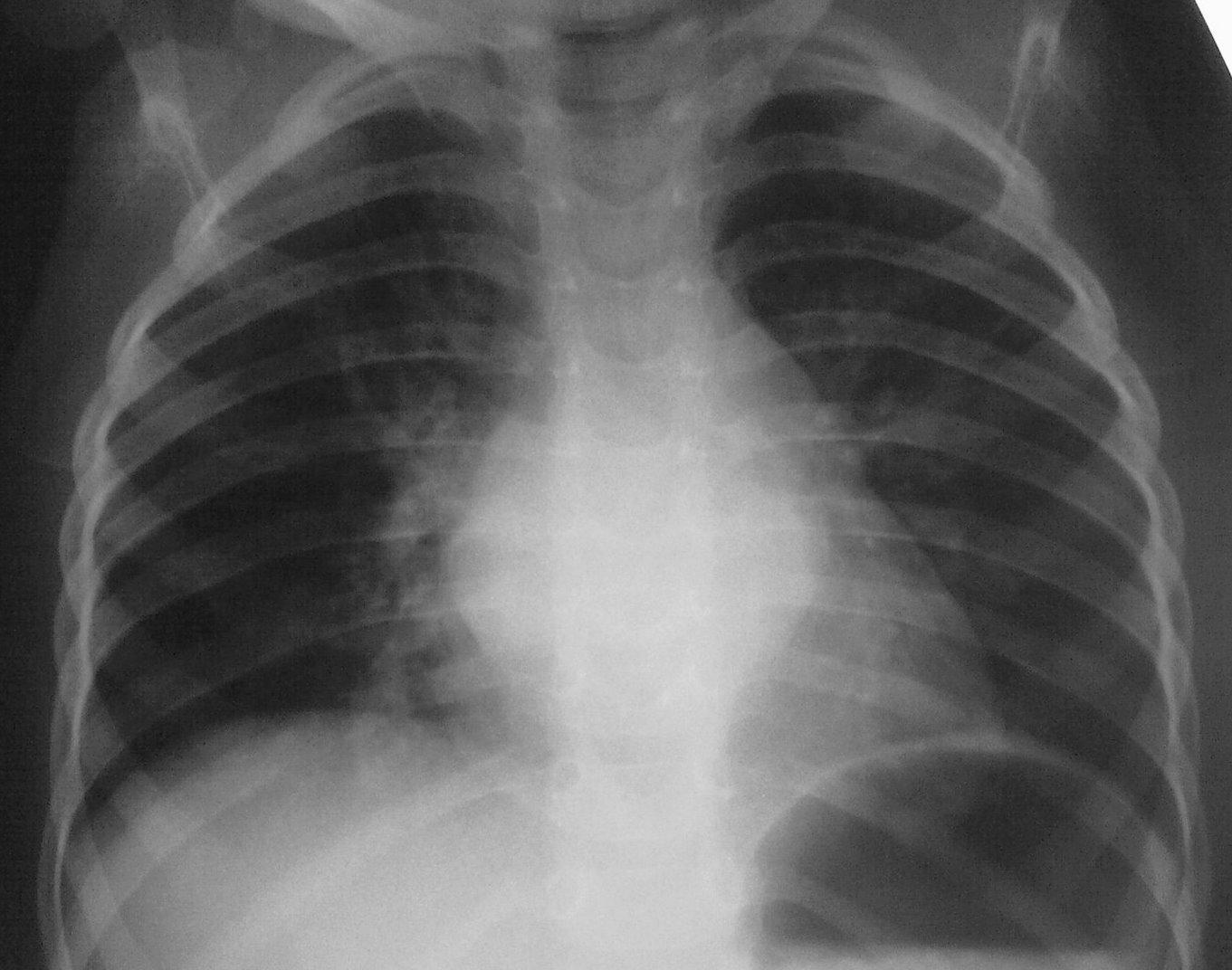 рентген-снимок легких