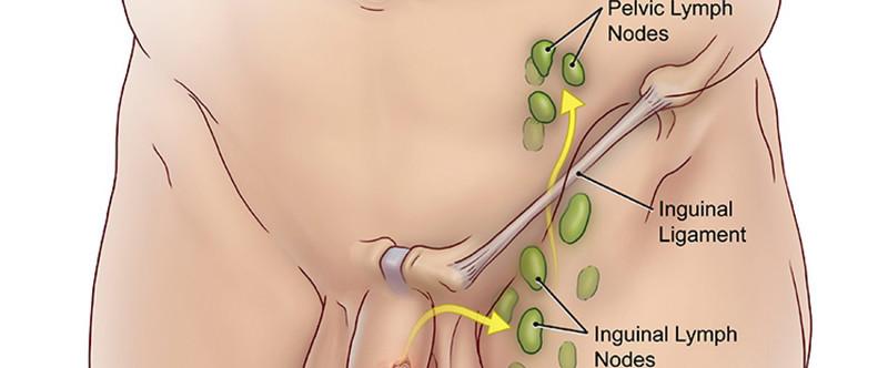 Поверхностные паховые лимфоузлы