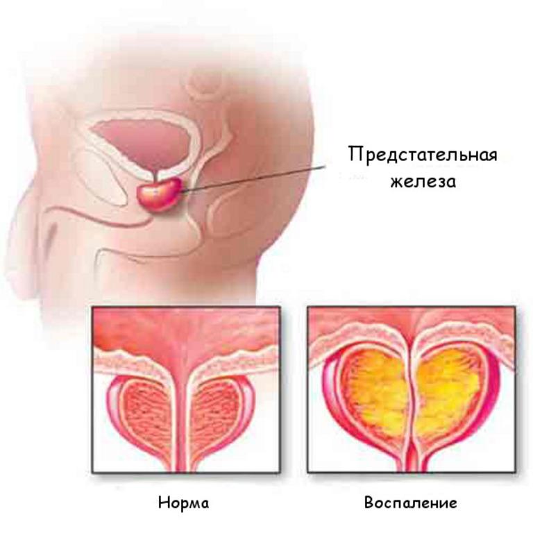 предстательная железа