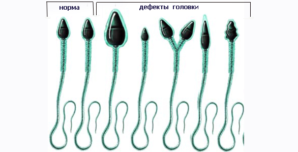 виды аномалий головки спермия