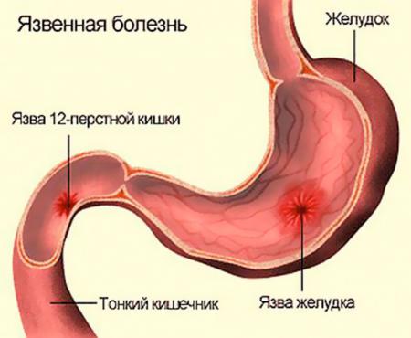 язвенная болезнь