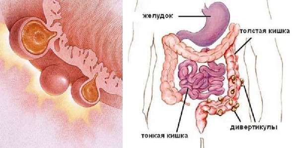 Дивертикулёз
