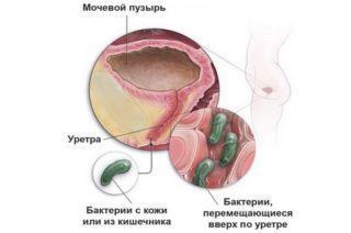 Способ проникновения бактерий и микробов в женскую уретру