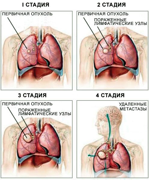 Все про Рак легких: первые симптомы и признаки, стадии, выживаемость