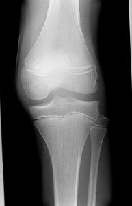 Перелом кости у колена