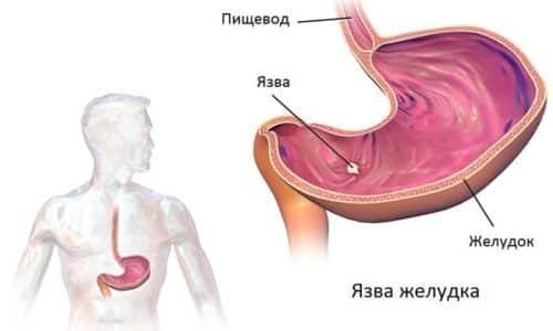 Запущенное заболевание поджелудочной железы может вызвать язву желудка и кишечника