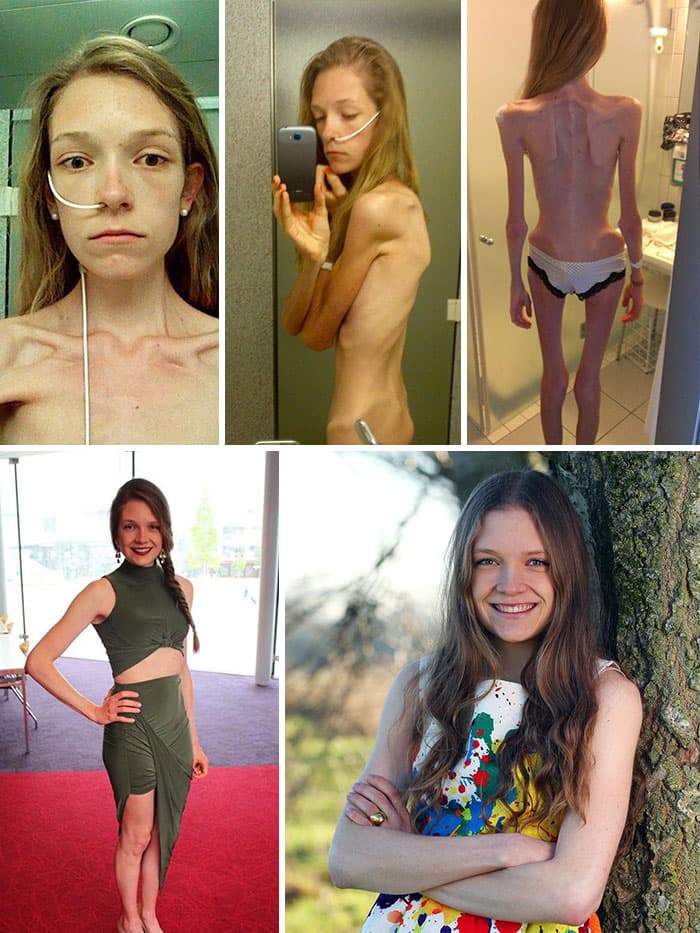 Анорексия: 40 фото «До и После»