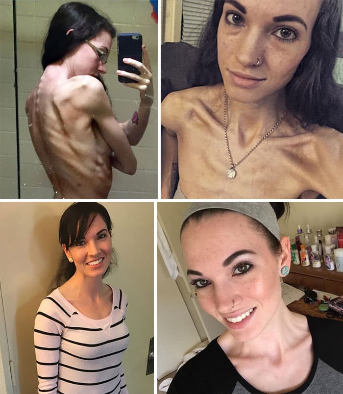 Анорексия: 40 фото «До и После»
