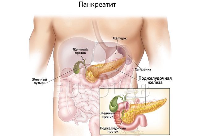Панкреатит - это воспаление поджелудочной железы