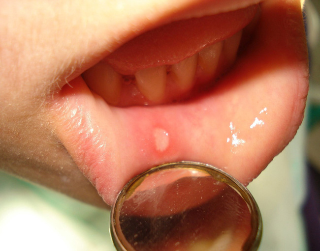 Болезненные мелкие язвы в полости рта периодически доставляют беспокойство примерно 30% населения, причем женщины жалуются на них чаще, чем мужчины, заболевание может начаться практически в любом возрасте