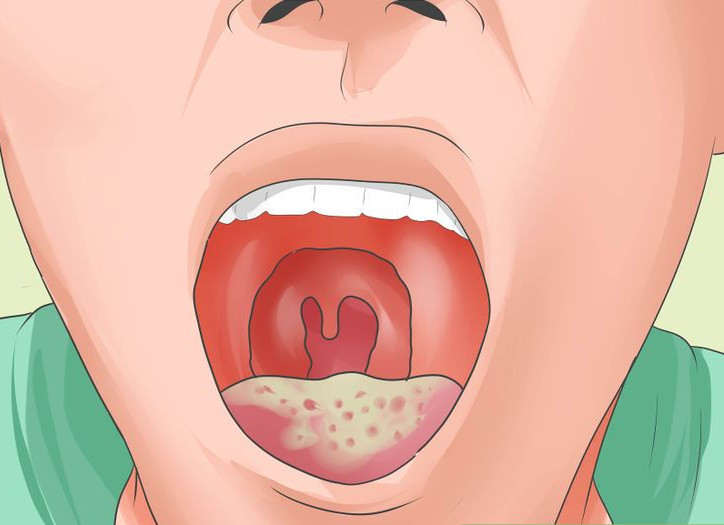 Специфические симптомы ВИЧ - бляшки, молочница во рту