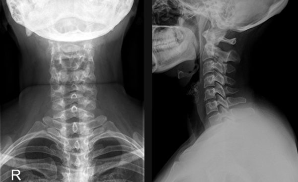 Рентген шейного отдела позвоночника
