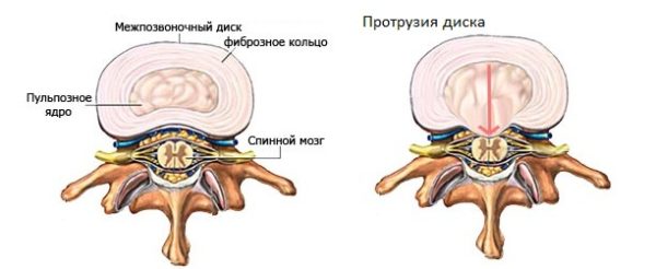 Протрузия диска