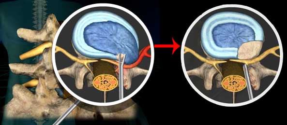 Перкутанная дискэктомия при грыже позвоночника