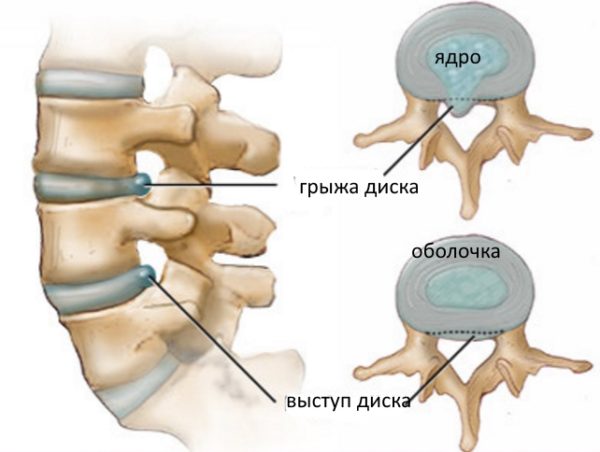 Протрузия и грыжа поясничного отдела