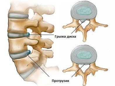 Межпозвоночная грыжа