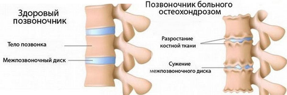 Остеохондроз