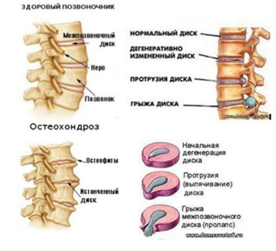 Остеохондроз позвоночника