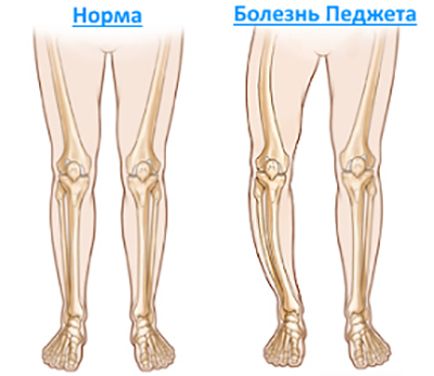 Болезнь Педжета