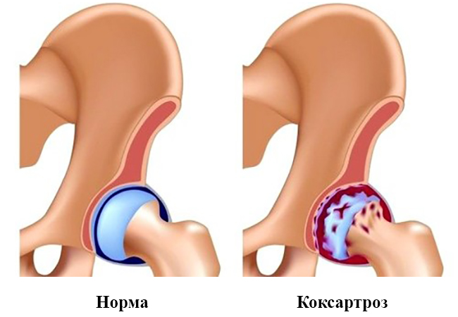 Норма и коксартроз