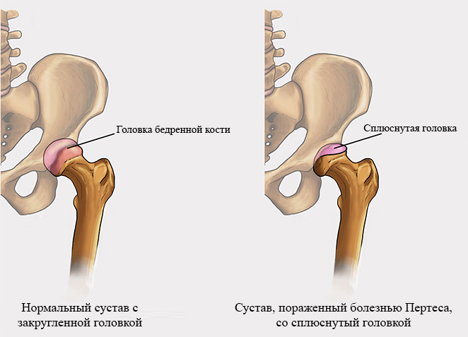 Болезнь Пертеса