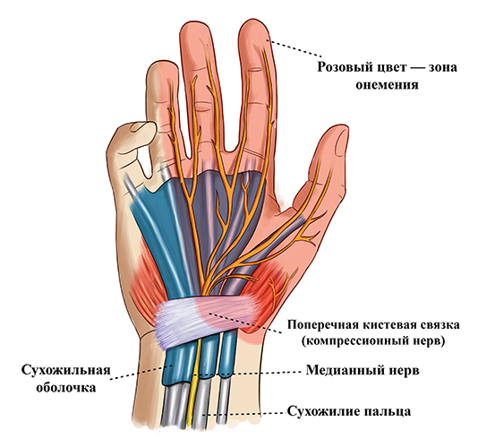 Туннельный синдром