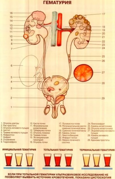 гематурия