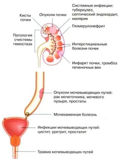 причины крови в моче