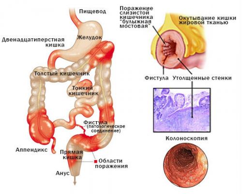 Болезнь Крона