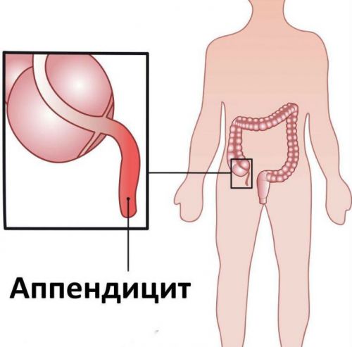 Аппендицит