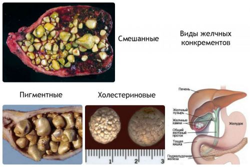 Камни желчного пузыря