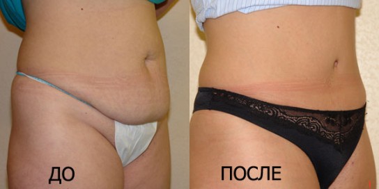 Похудение: до и после