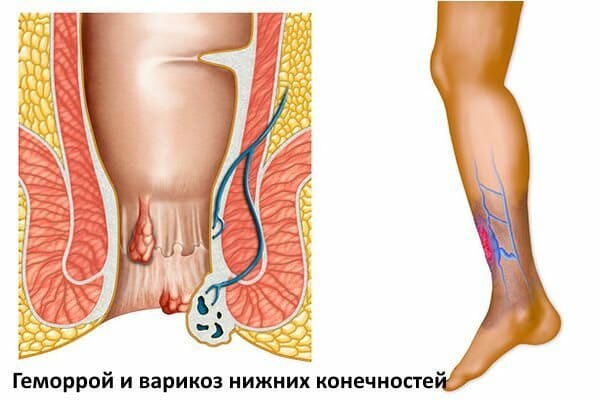 Геморрой и варикоз нижних конечностей