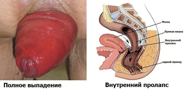 Выпадение прямой кишки 