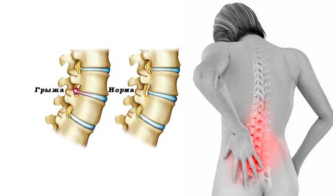 Лучшие упражнения Дикуля для спины при грыже различных отдела позвоночника