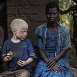 В Африке охотятся на детей-альбиносов для черных магов